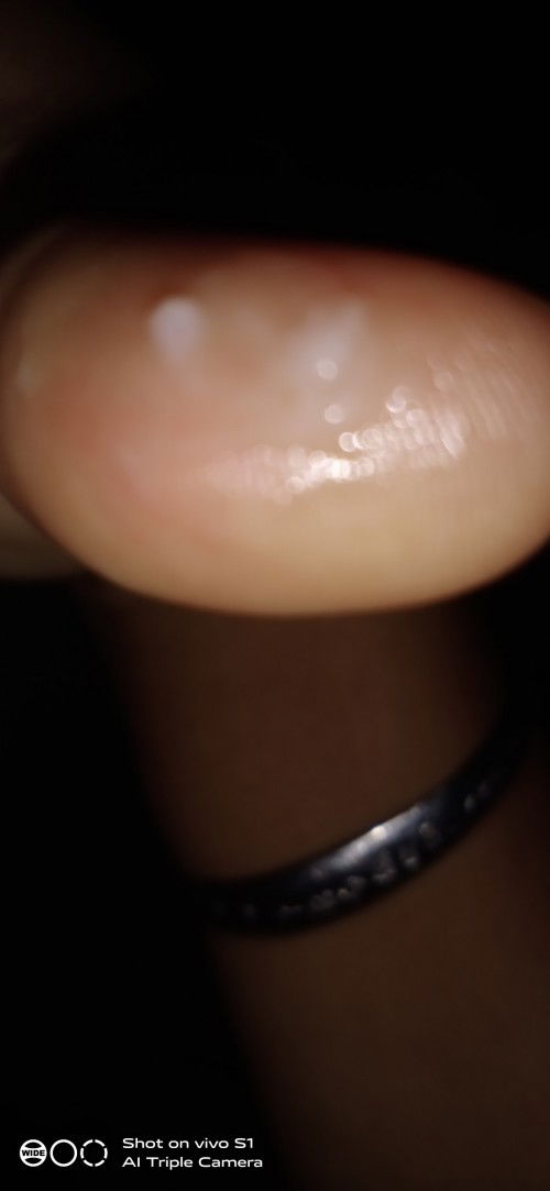 ขอสอบถามหน่อยค่ะท้อง37+3 มีตกขาวไหลเปียก กกน เกือบทั้งวัน แบบนี้ปกติไหมคะ. ไหลซึมจิมิ  สีใสขาวๆขุ่นเ