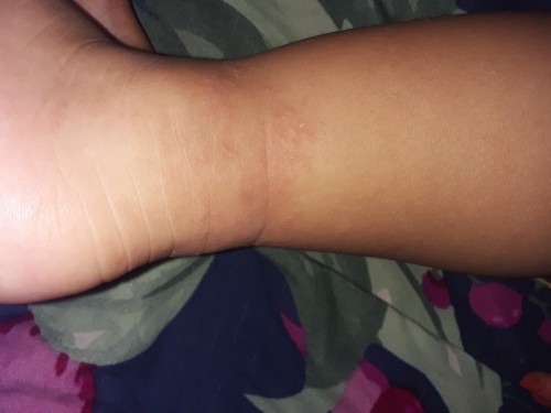 Bun mau nanyak ini kaki ank saya knpa ea,,& supaya cpt sembuh di ksh obat apaπππ