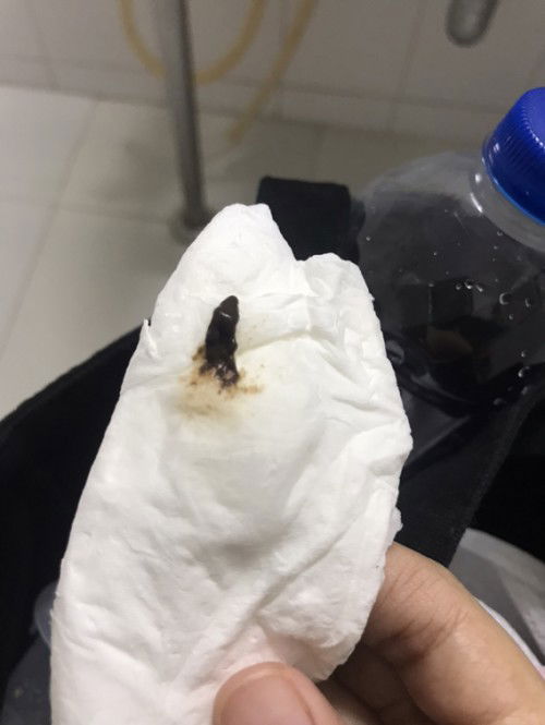 ท้อง 23 week มีตกขาว มูกสีน้ำตาลออกมา