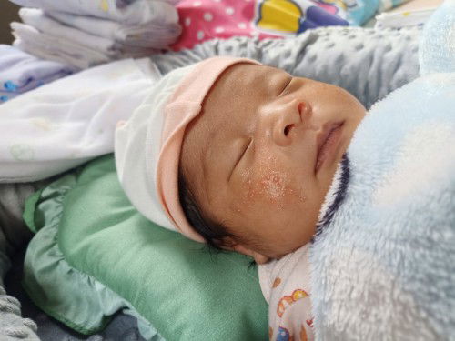 หน้าน้องเป็นผื่น   รักษายังไงค่ะ