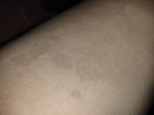 Bercak hitam pada paha