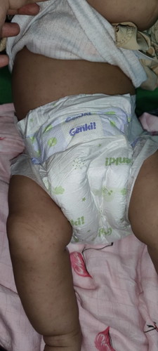 Salam semua..
saya nak tanya siapa yg ada pengalaman baby 5 bulan naik bintik macam ni. . kenapa ye?