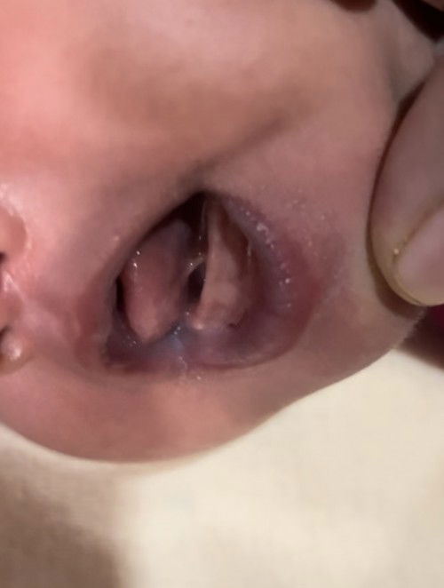 Mau tanya ini termasuk tounge tie gak bun