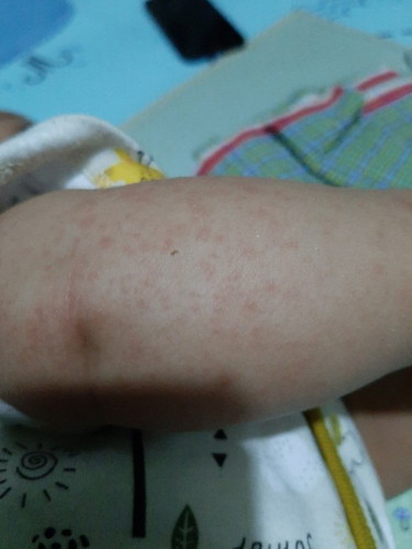 Bintik merah di badan bayi. Adakah yg mengalami hal sama bun?