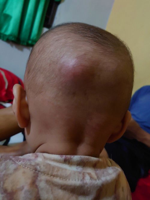 benjolan belakang kepala