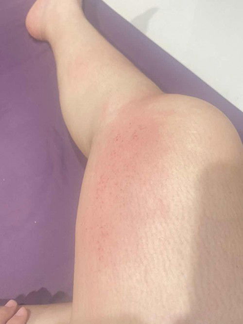 ท้อง 27 สัปดาห์  มีผื่นขึ้นที่แขนกับขา