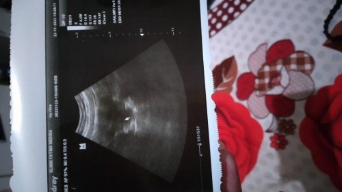 Tespack positif, hasil usg penebalan dinding rahim.