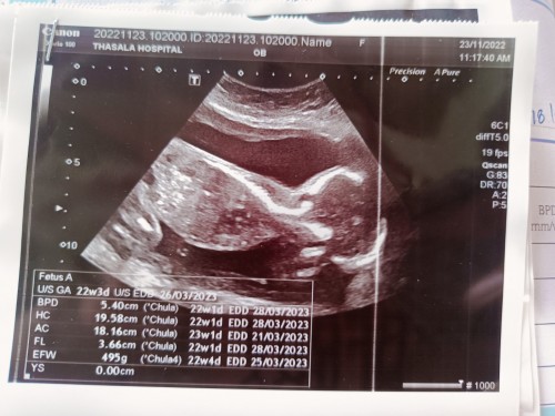 ตั้งครรภ์ท้องที่3 ลูกสาว