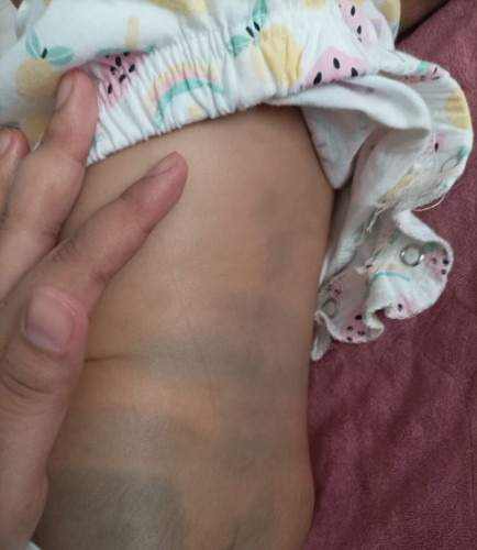 Tanda hijau di badan bayi