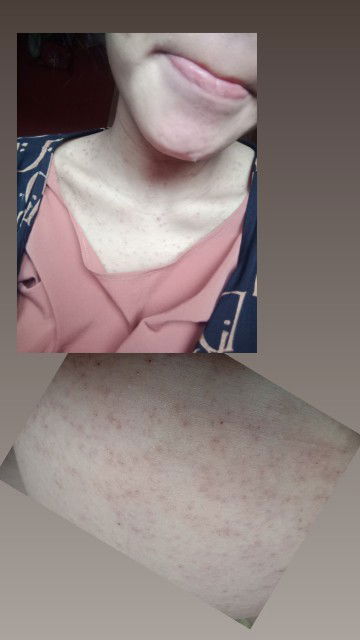 Gatal² pada usia kehamilan 6 buln, smpe skrg blm sembuh sudah 27 week.