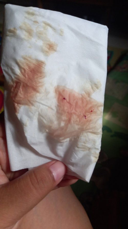 Flek di usia kehamilan 7 w normal kah. Tidak merasakan nyeri sedikit kram ringan saja