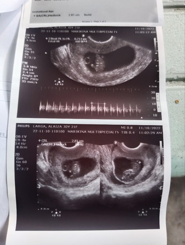 Sinu Po marunung tumingin Ng ultrasound kung NASAn placenta