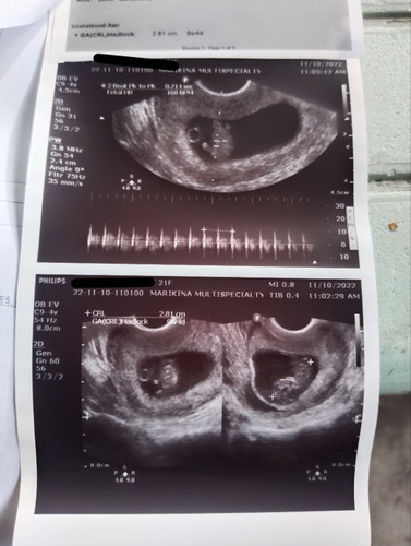 Sinu Po marunung tumingin kung NASAn nka pwesto placenta