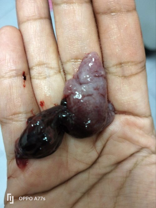 Haid keluar darah macam daging kenapa ya?