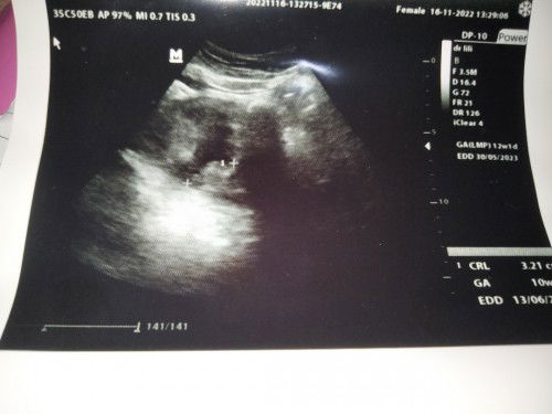 Hasil USG kehamilan.