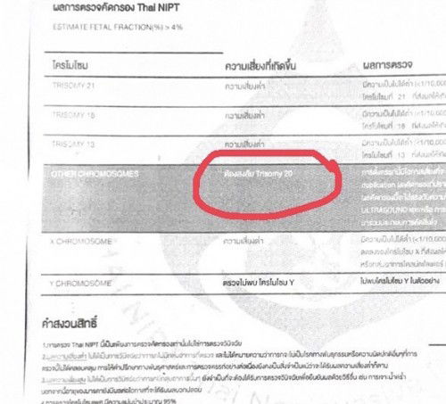 โครโมโซมคู่ที่ 20 ผิดปกติ