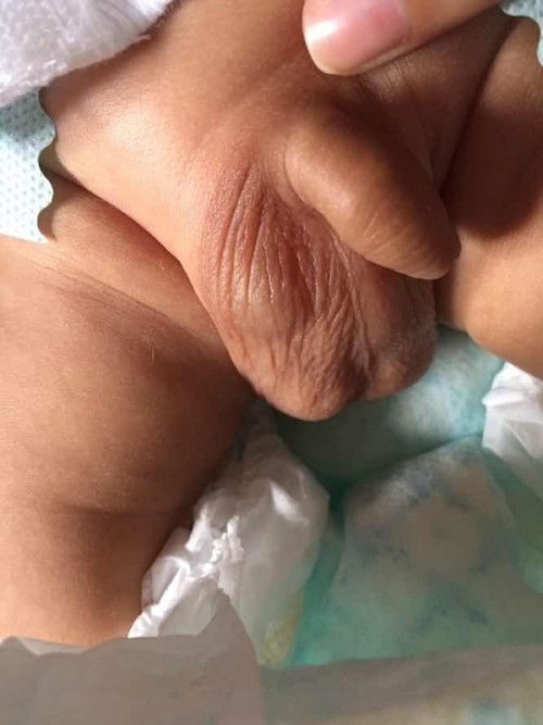 Bukol sa Scrotum ni baby