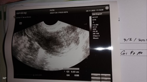 ukuran GS yg normal untuk 4 week berapa bun?saya jadi worry karna GS nya masih kecil bgt kata dokter