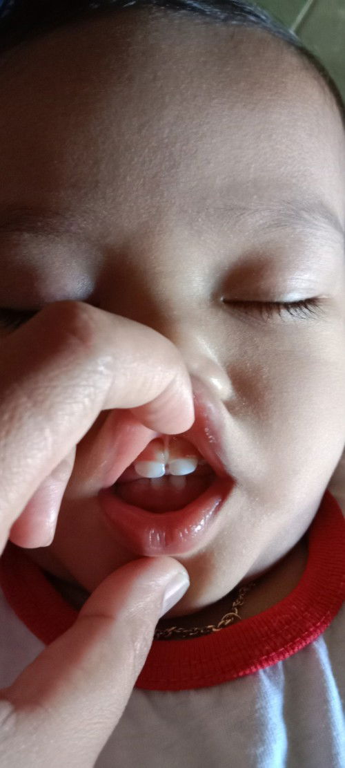 Assalamu'alaikum bun 
Mohon tanggapannya ya bun
Ini termasuk lip tie atau bukan??? 
TerimaKasih..