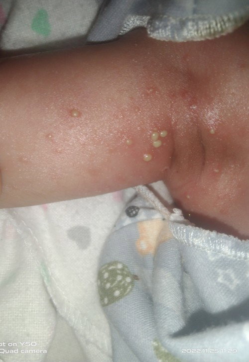 Bayi 15 hari muncul bintik bernanah
