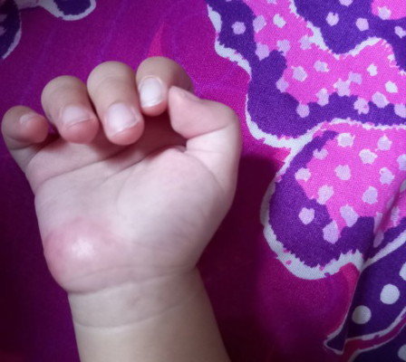 Telapak tangan bayi merah
