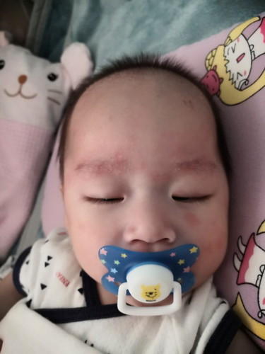 เวลาง่วงลูกชอบเอามือถูหน้าไปมา จนกว่าจะนอน หน้าแดงพังหมดเลย 😭