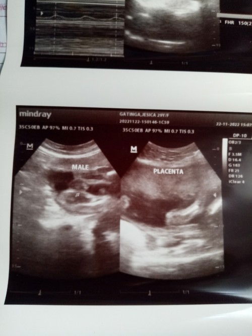 Hello po mga momshie. Okay lang po ba naka cephalic na 6months ko palang?