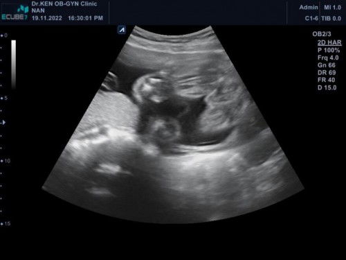 ดูเพศน้องให้หน่อยค่า