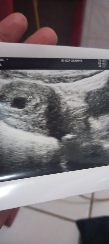 Setres , tidak ada dukungan keluarga, suami acuh.. berakibat fatal kepada mental dan sikis saya?