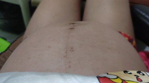 Ano kaya tong bglang tumubo sa tummy ko?