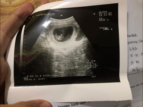 Diusia kehamilan 9 minggu