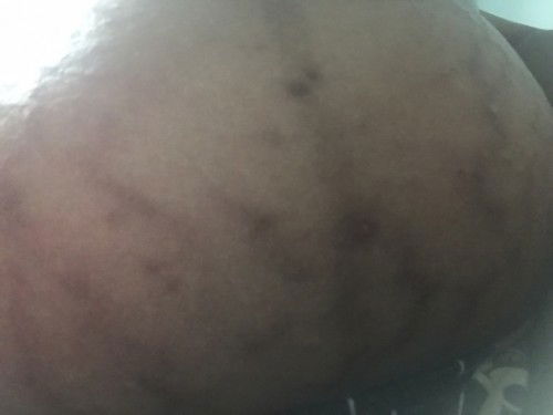 คันท้องแตกลาย