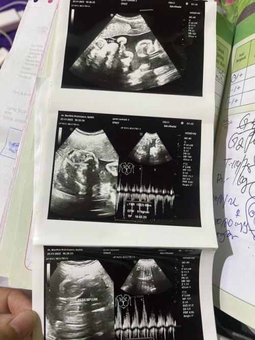 Cara cepat naikan Bb janin