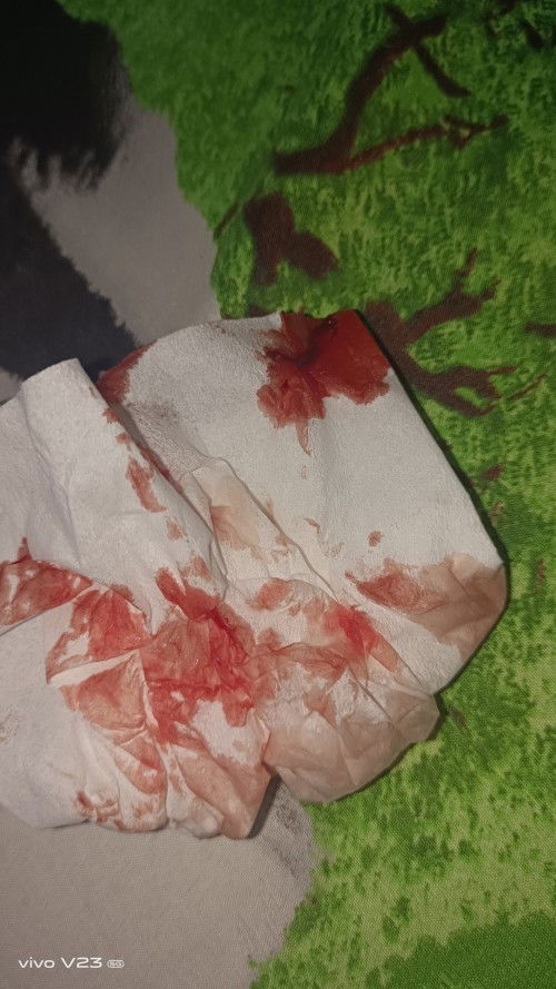 Mau nanya nih bunda² bagi yang udah berpengalaman pernah suntik pematang paru