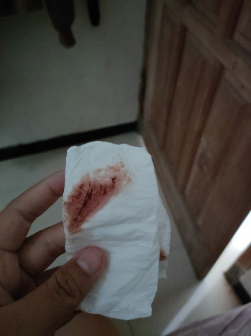 Flek coklat lagi di kehamilan 8 minggu