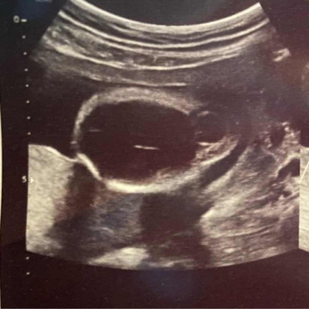 Ketulan semasa ultrasound