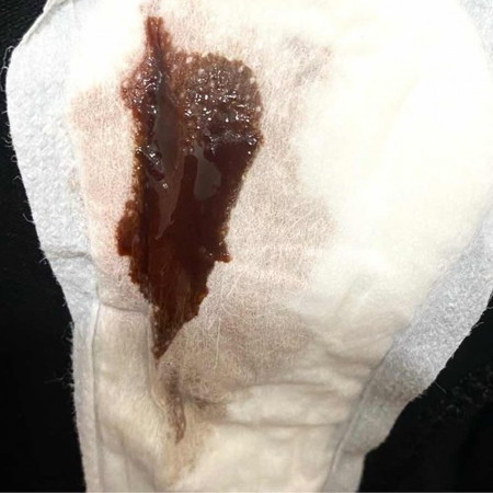 Flek coklat