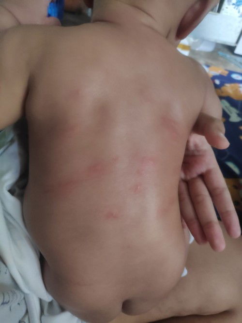 เมื่อวานลูกมีตุ่มแดงแบบในรูป 3_4ตุ่ม พอวันนี้ขึ้นเยอะ เกิดจากอะไรคะ พาไปหาหมอดีมั้ยค่ะ