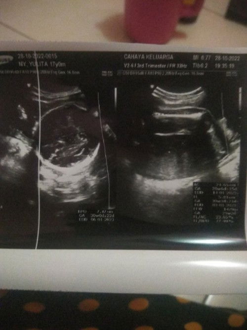 Hpl bidan 31desember hpl dokter pas USG 14 Januari maaf bund nannya akuratan yang mana y