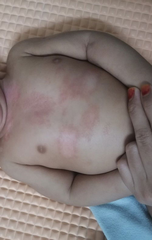 Merah ii pada badan baby