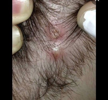 Hello mga mi. My ganto po baby ko. Parang pimple malalaki. Ano po kaya pwedeng ointment