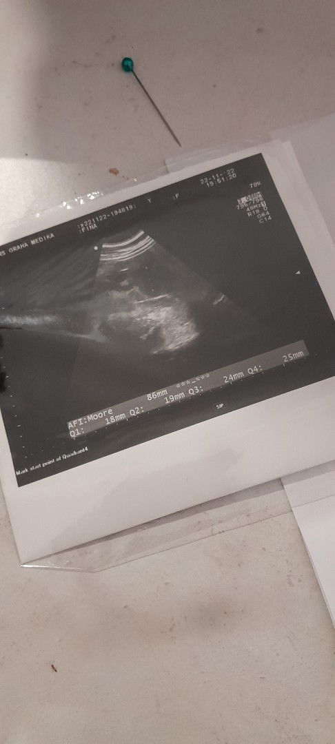 Mau nanya dong bun seputar fiagnosa oligohidramnion