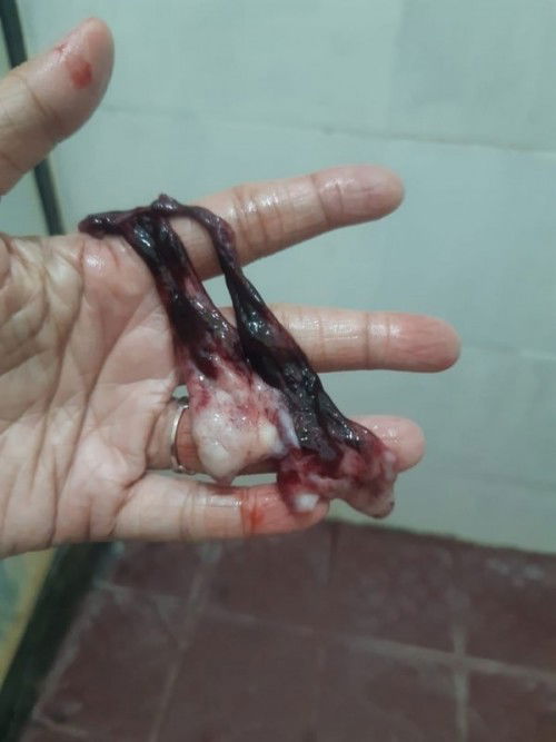 Apa ini keguguran atau miom?