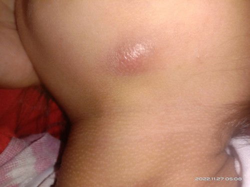 Benjolan dibawah Dagu