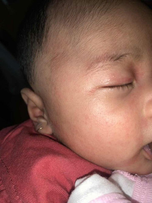 Wajah anak merah merah