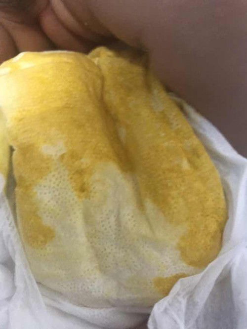 normal po ba ganto poop ni baby? pure bf po 1 and half month nasi baby.
twice a day lang tae nya.