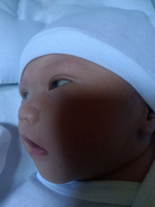 Red line sa Mata ni baby