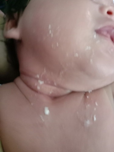 Jeluak susu berketul2