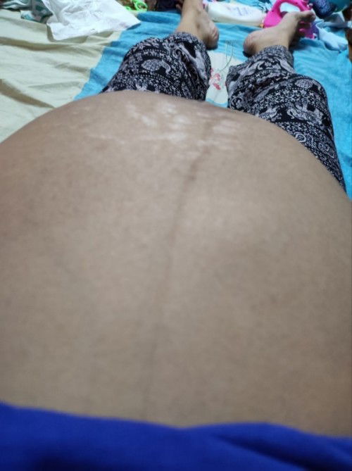 36   วีค แล้ว คุณแม่ท่านไหนมีประสบการณ์ ผ่าคลอดท้อง 3 บ้าง อาการมันเจ็บมากกว่าท้องก่อนไหม