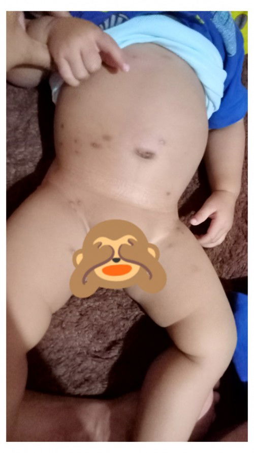 Usia 10 bulan, digigt serangga/nymuk lngsung merah gatal bekasnya hitam susah ilang. Harus pake apa?